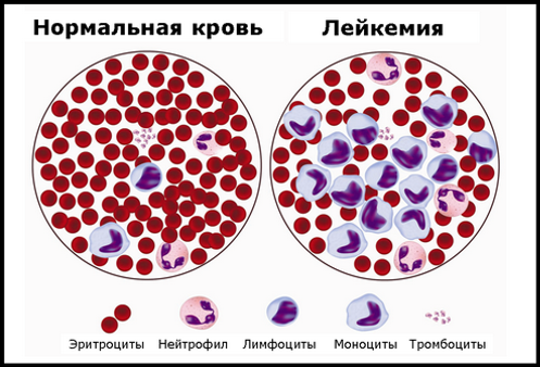 Лейкемия (рак крови)